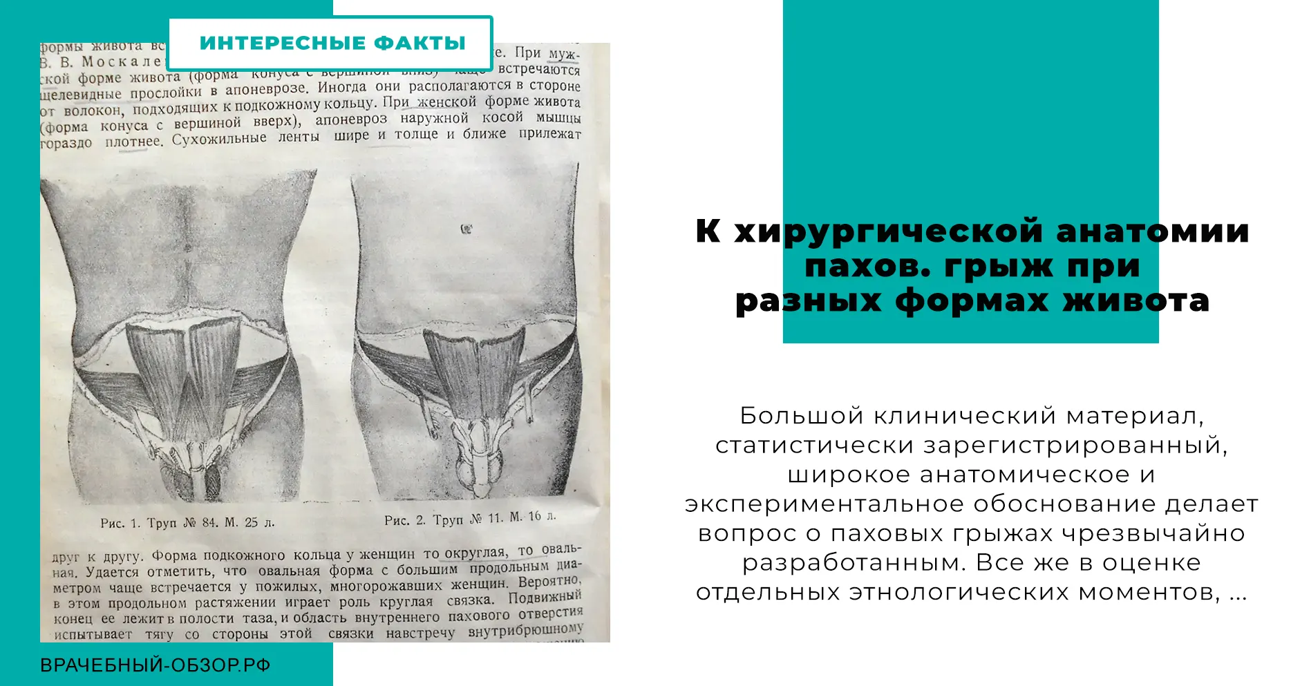 К хирургической анатомии пахов. грыж при разных формах живота