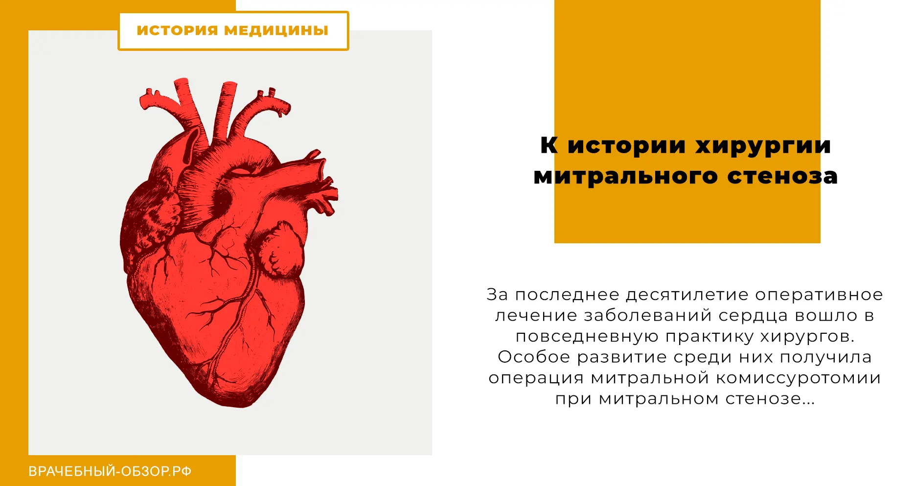 К истории хирургии митрального стеноза