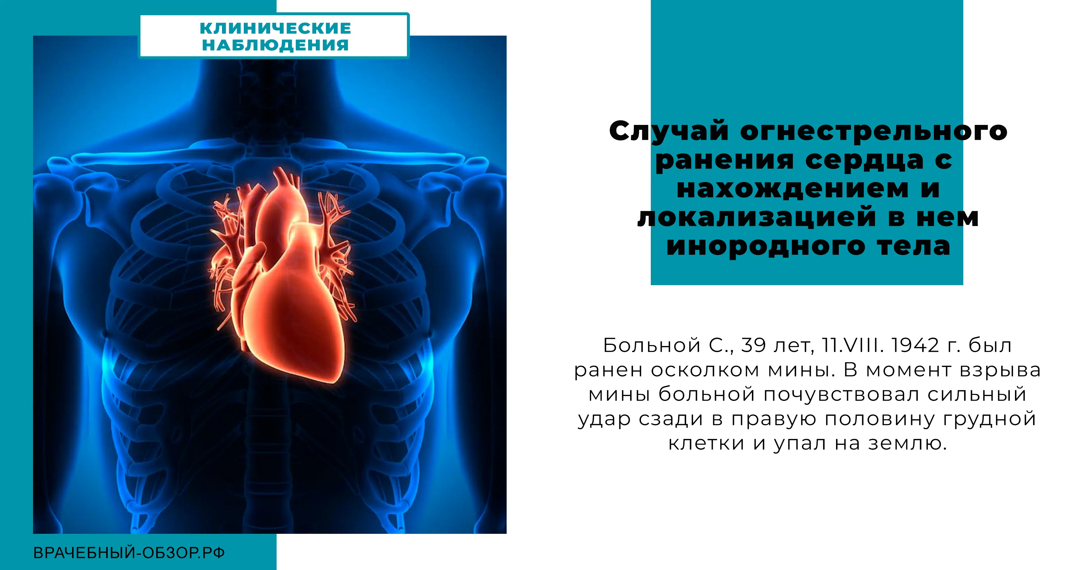Cлучай огнестрельного ранения сердца с нахождением и локализацией в нем инородного тела